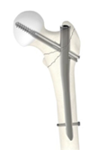 A bone with screws attached to it

AI-generated content may be incorrect.